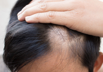 Hair Loss Stage Illustration