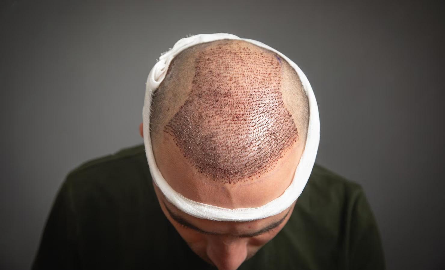 Hair Transplantation (FUE/FUT as indicated)