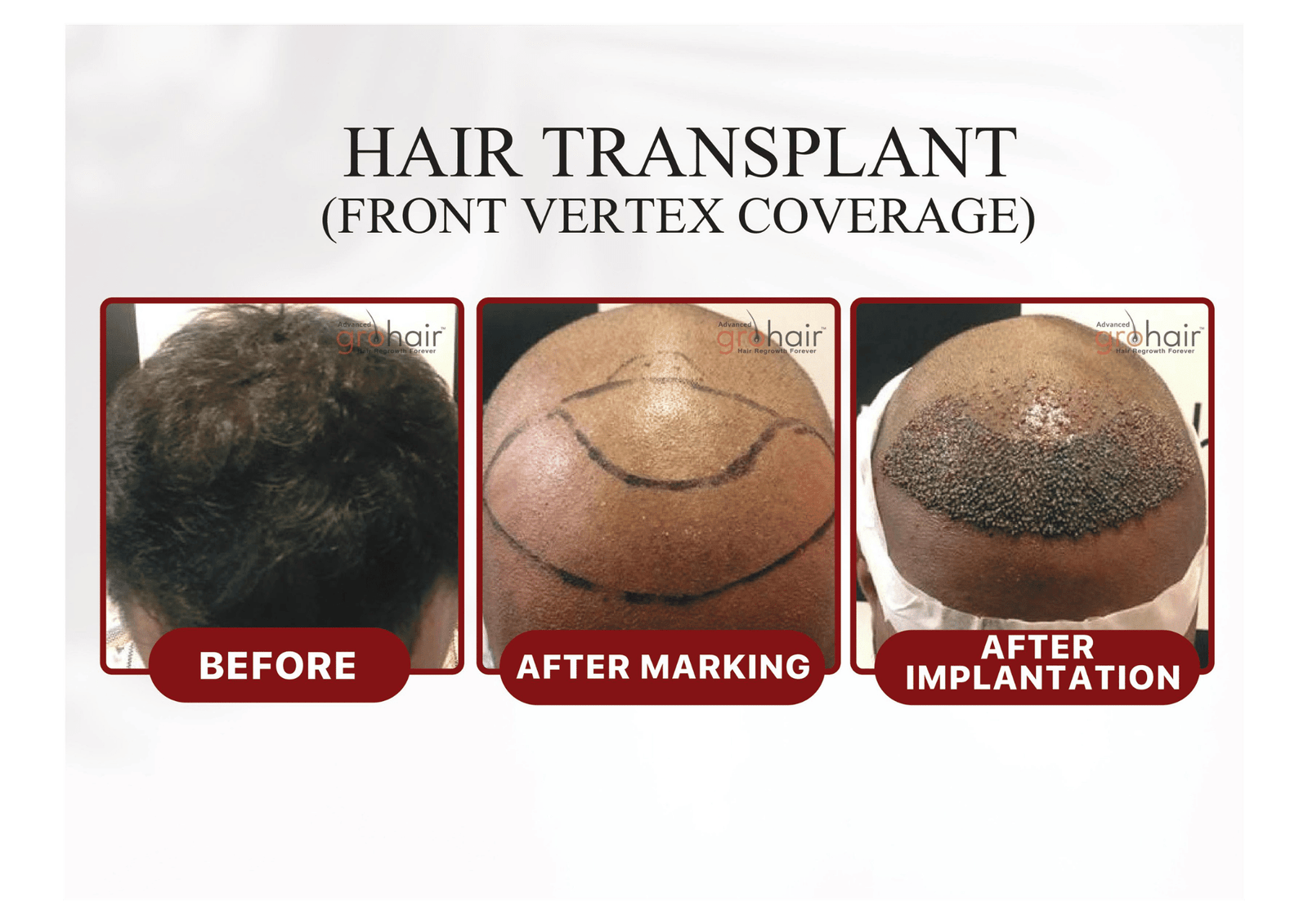 Before - DHI Technique