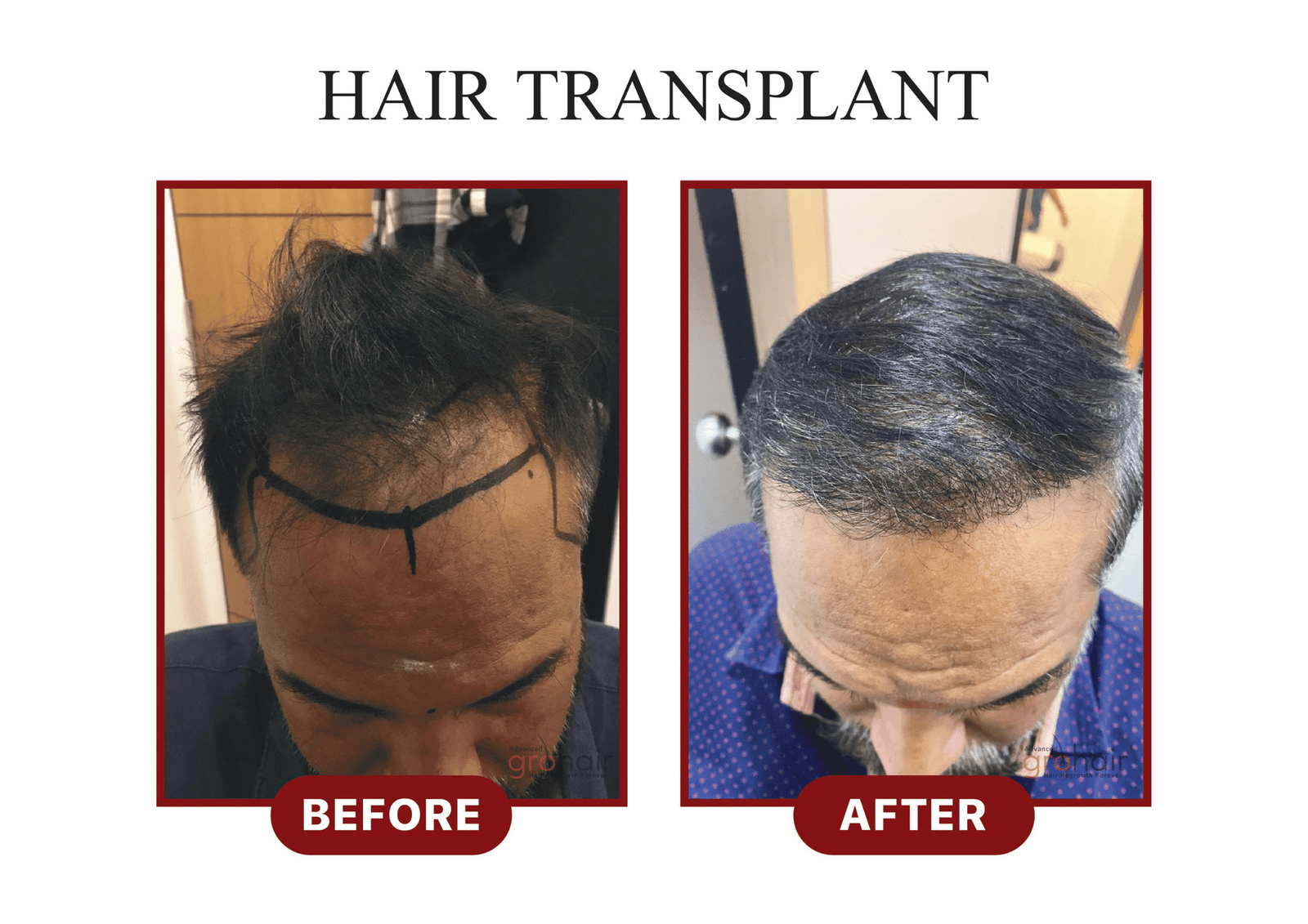Before - FUE Hair Transplant