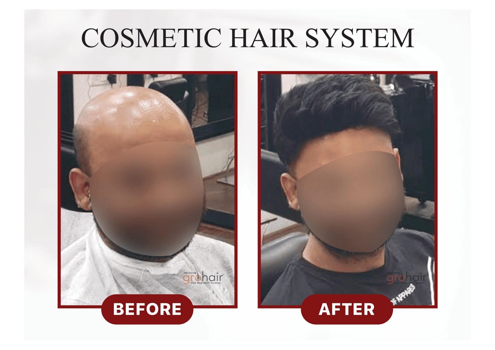 After - DHI Technique