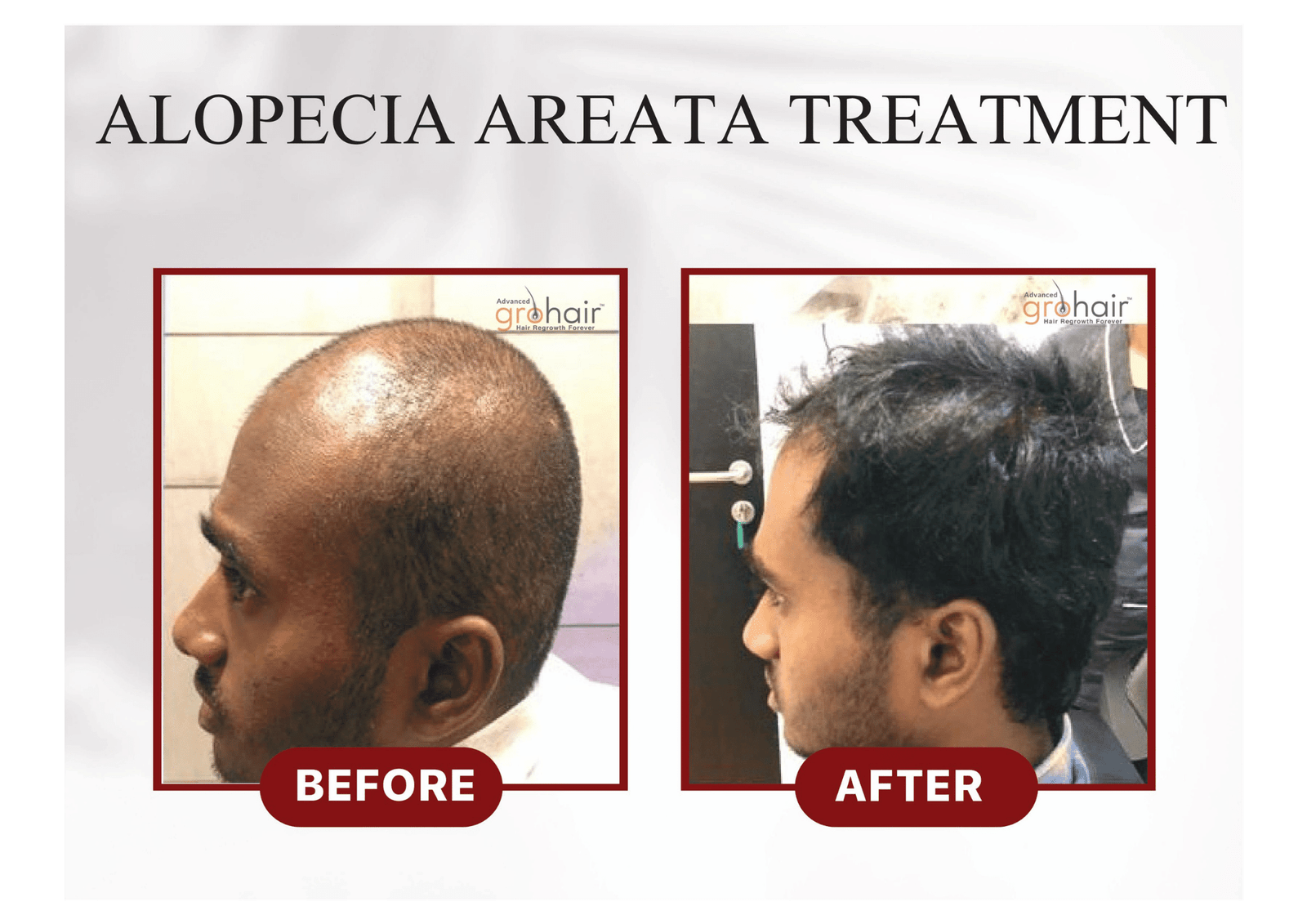 After - FUE Hair Transplant